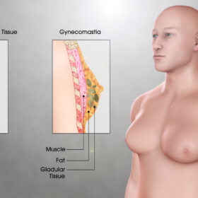 What is Gynecomastia? How do steroids cause Gynecomastia? 5